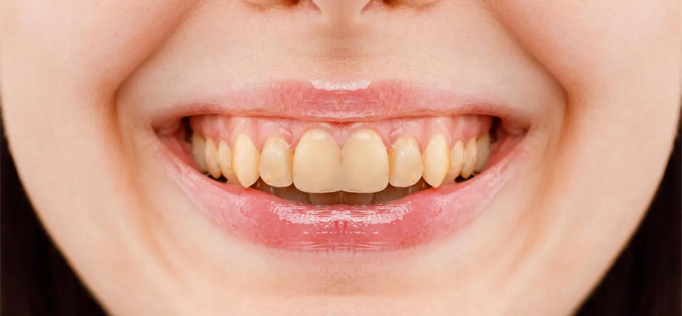 Before teeth whitening at Smile Care Studio, Thunder Bay